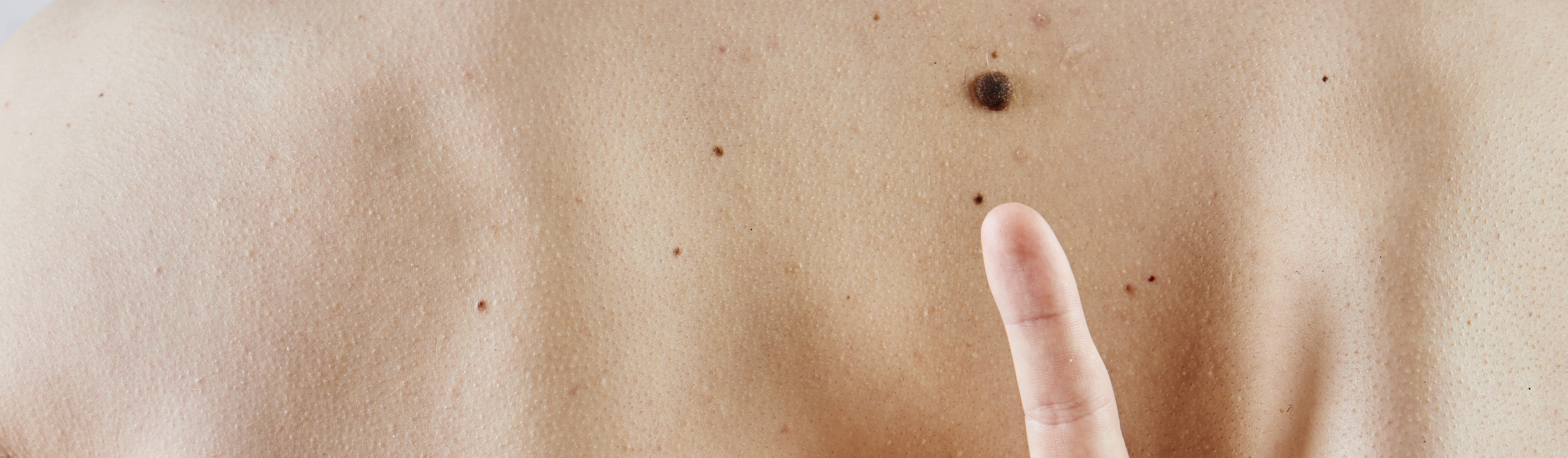 Dermatoskopia 2