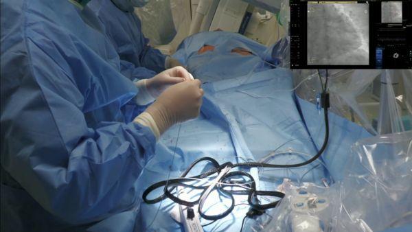 Angioplastyka zmian uwapnionych techniką aterektomii rotacyjnej. Kiedy i&nbsp;w&nbsp;jaki sposób bezpiecznie wykonać zabieg